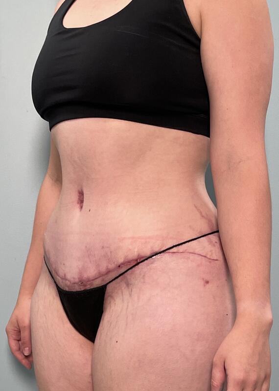 Tummy Tuck Before & After Image