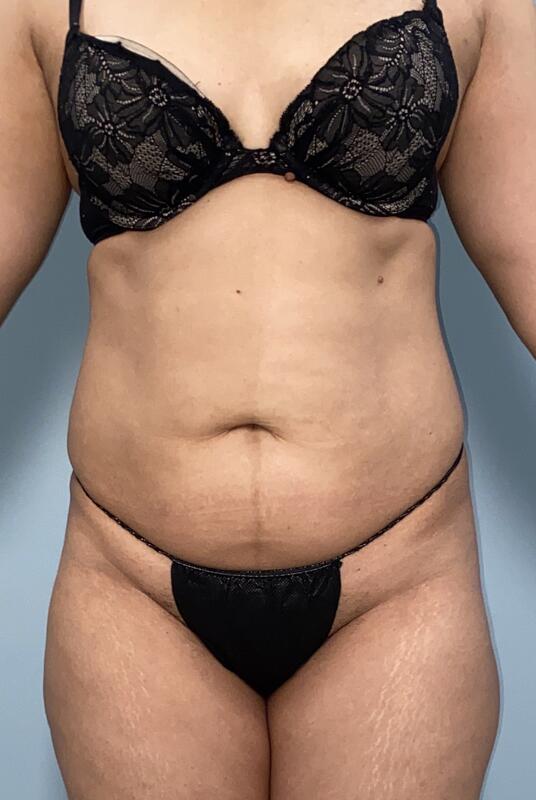 Tummy Tuck Before & After Image