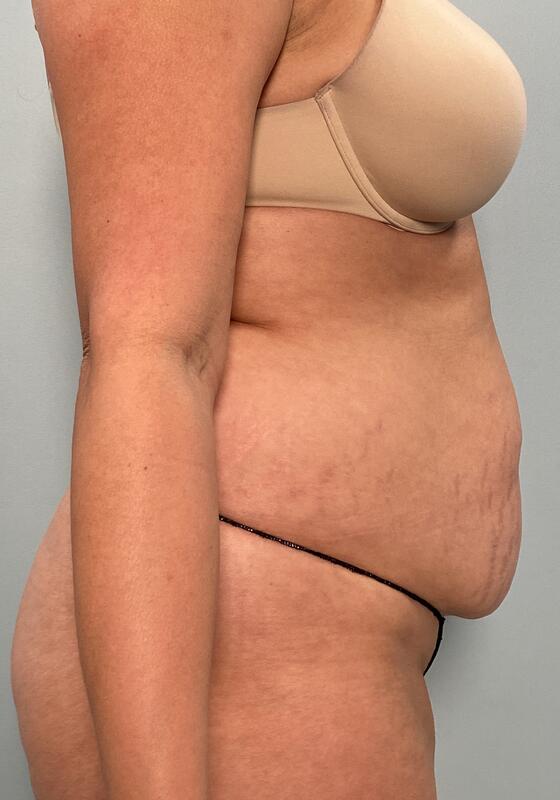 Tummy Tuck Before & After Image