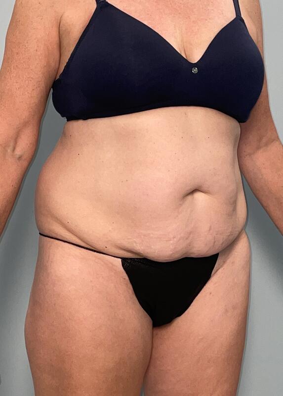 Tummy Tuck Before & After Image