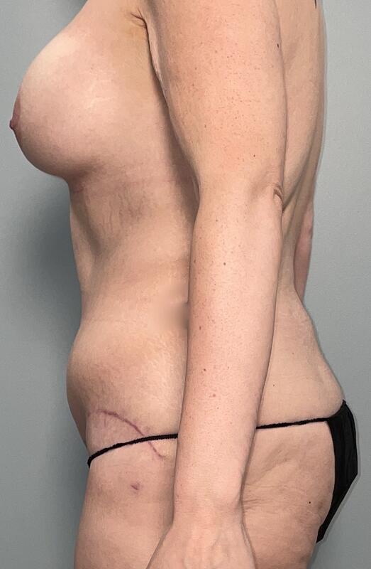 Tummy Tuck Before & After Image
