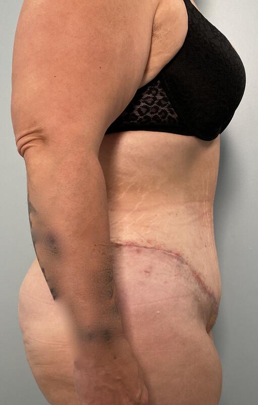 Tummy Tuck Before & After Image