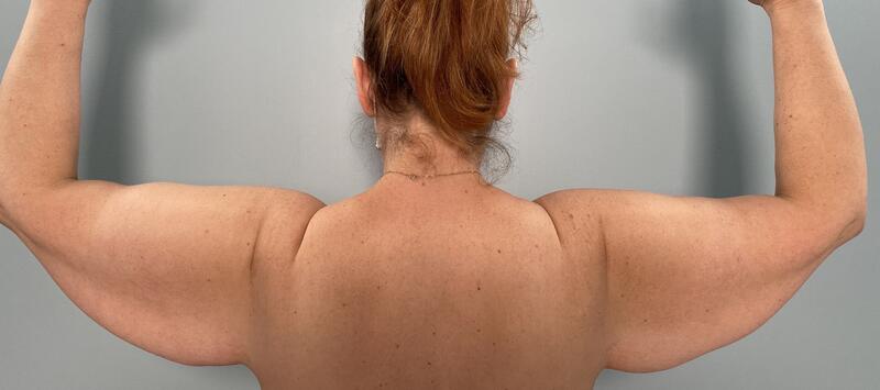 Arms & Thighs Before & After Image