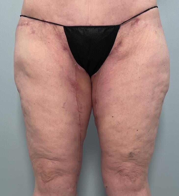 Arms & Thighs Before & After Image