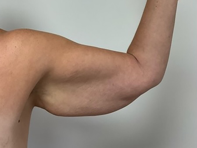 Arms & Thighs Before & After Image