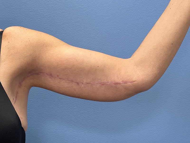 Arms & Thighs Before & After Image
