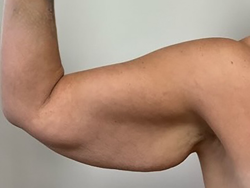 Arms & Thighs Before & After Image