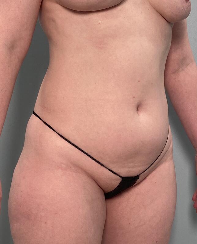 Liposuction Before & After Image