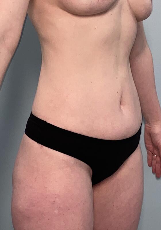 Liposuction Before & After Image