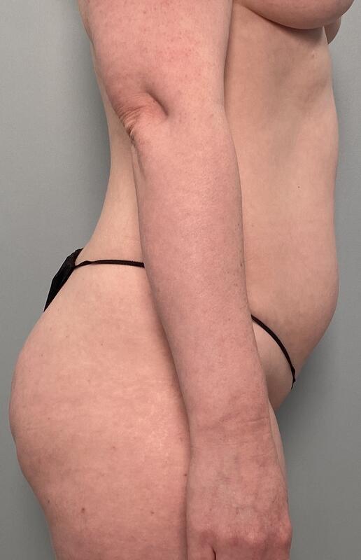 Liposuction Before & After Image