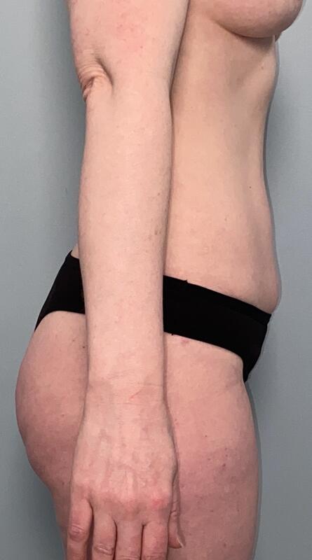 Liposuction Before & After Image