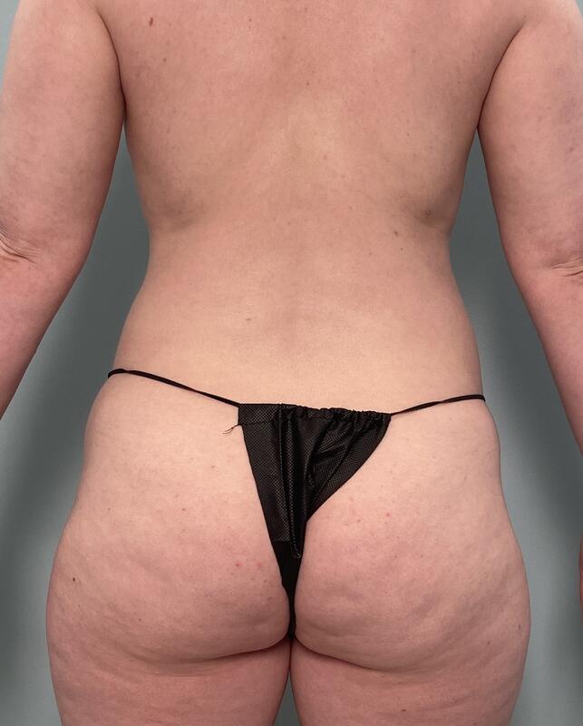 Liposuction Before & After Image