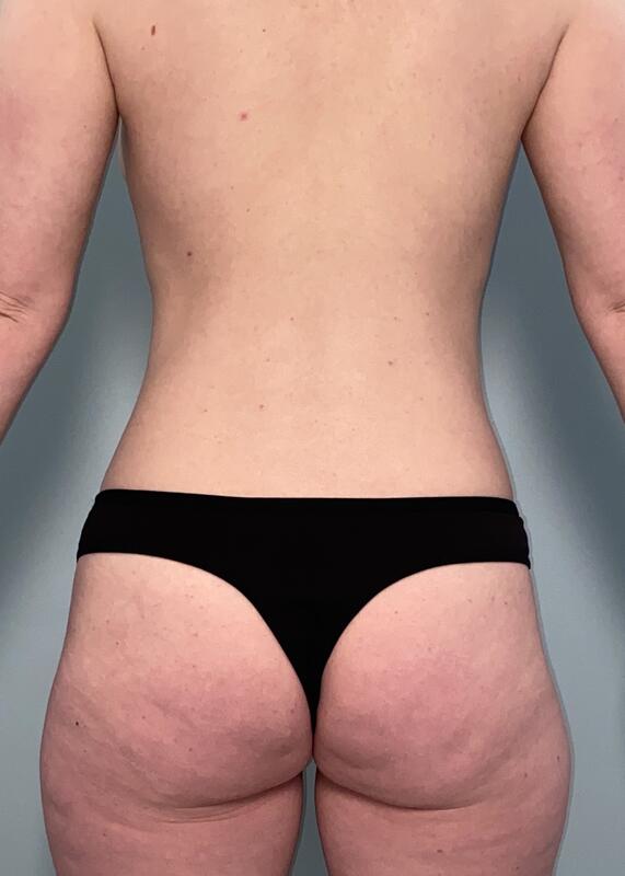 Liposuction Before & After Image