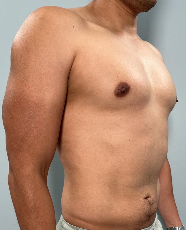 Liposuction Before & After Image