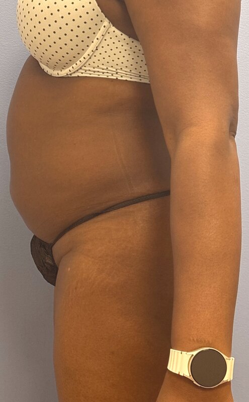 Liposuction Before & After Image