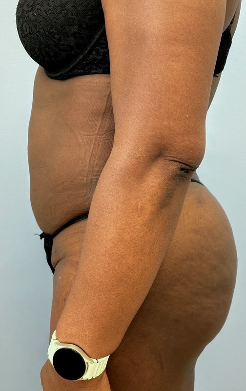 Liposuction Before & After Image