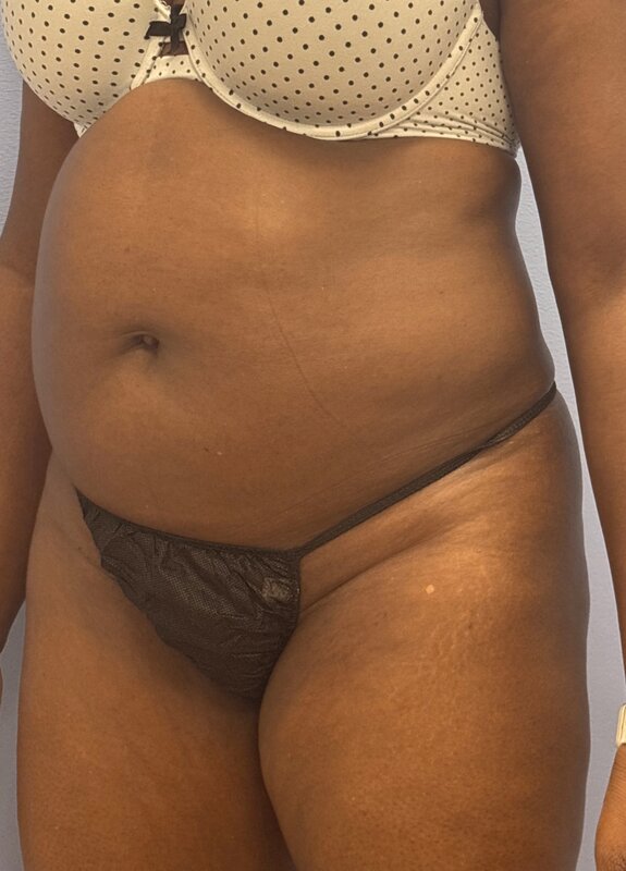 Liposuction Before & After Image