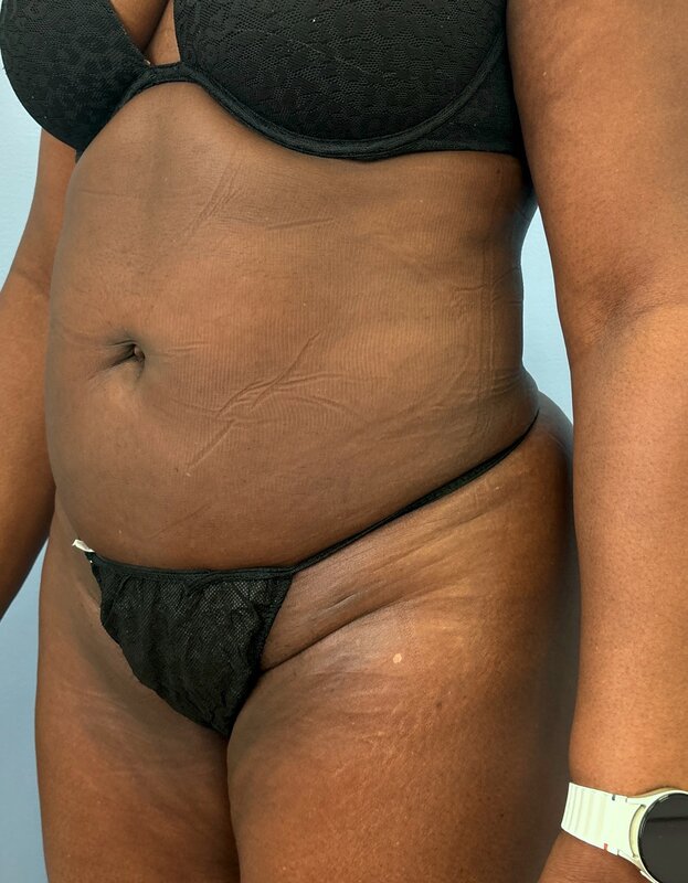 Liposuction Before & After Image