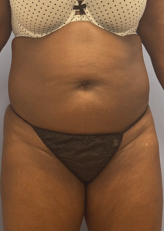Liposuction Before & After Image