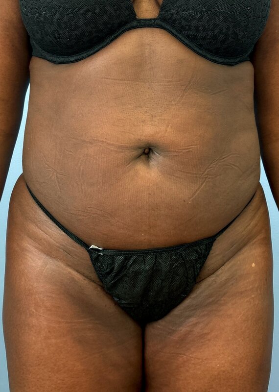 Liposuction Before & After Image