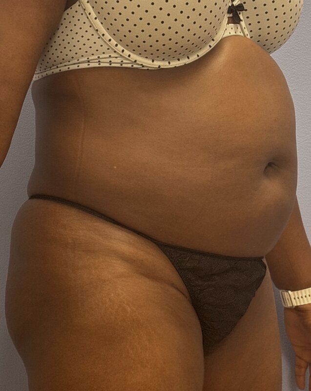 Liposuction Before & After Image