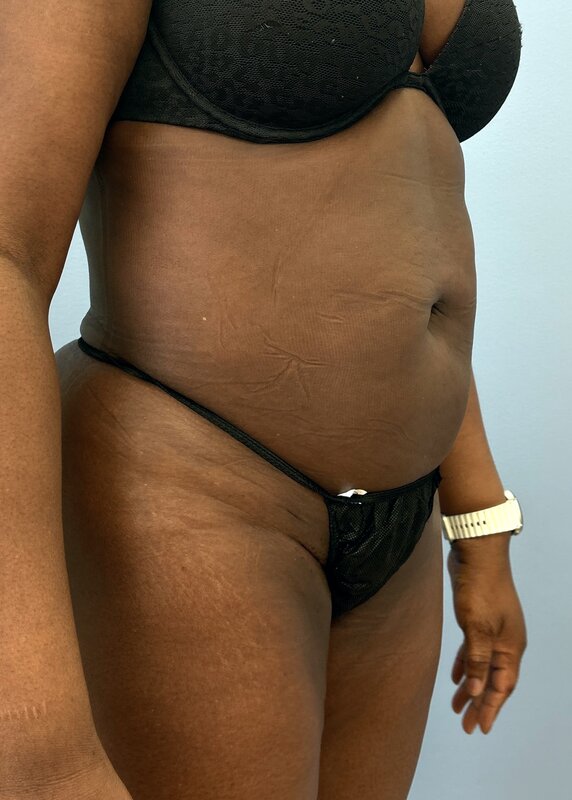 Liposuction Before & After Image
