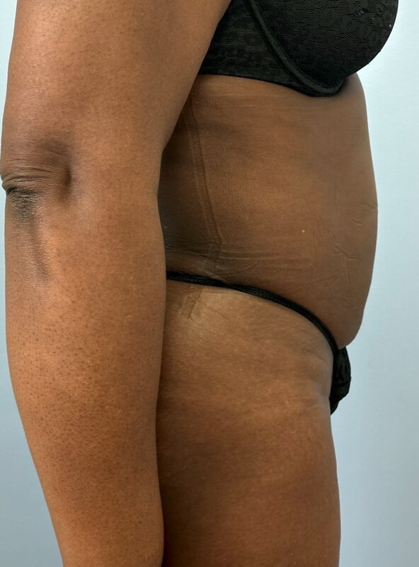 Liposuction Before & After Image