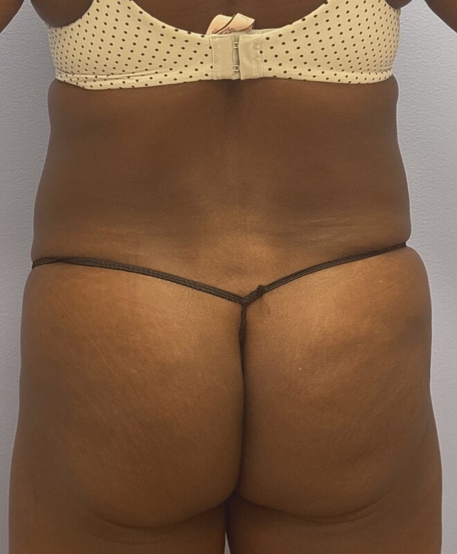 Liposuction Before & After Image