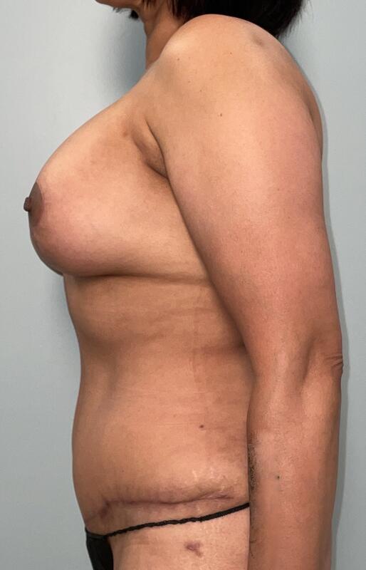 Mommy Makeover Before & After Image