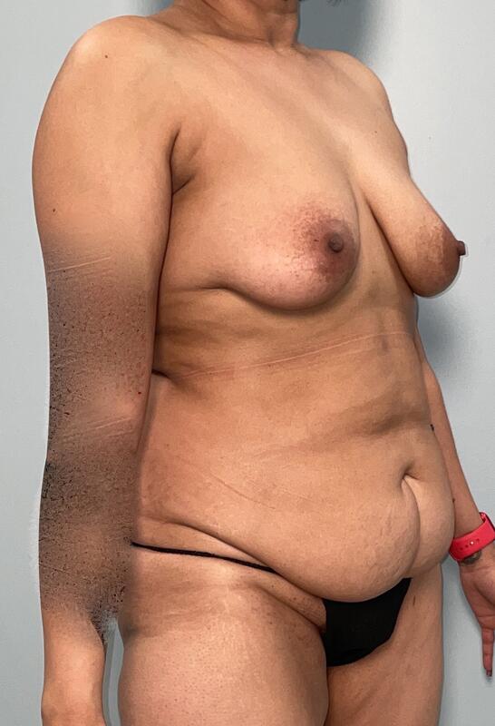 Mommy Makeover Before & After Image