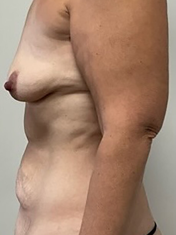 Mommy Makeover Before & After Image