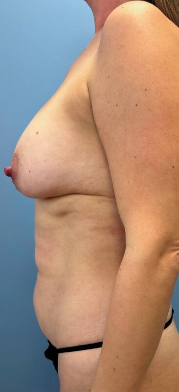 Mommy Makeover Before & After Image