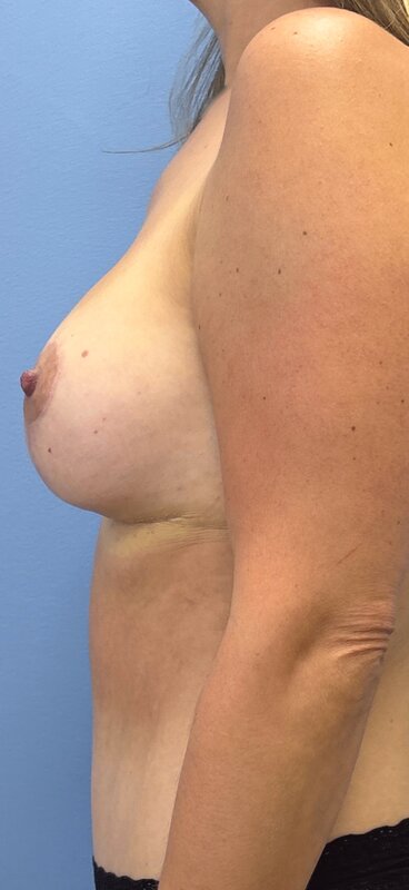 Mommy Makeover Before & After Image
