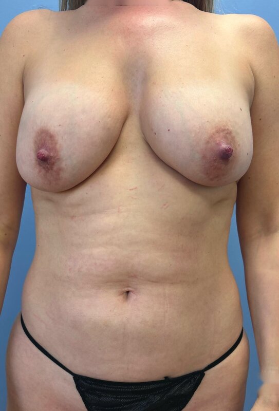 Mommy Makeover Before & After Image