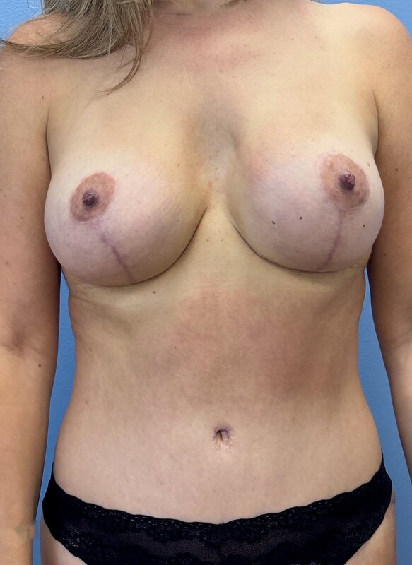 Mommy Makeover Before & After Image