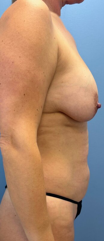 Mommy Makeover Before & After Image