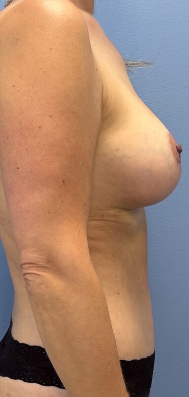 Mommy Makeover Before & After Image