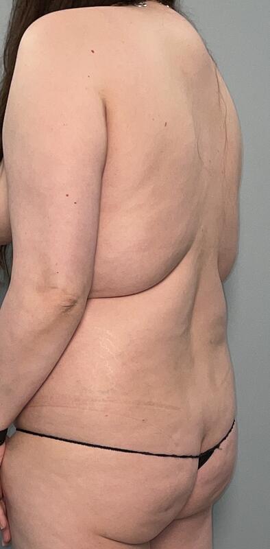 Upper Body Lift Before & After Image