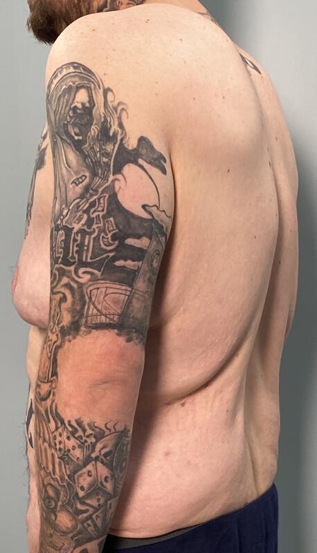 Upper Body Lift Before & After Image