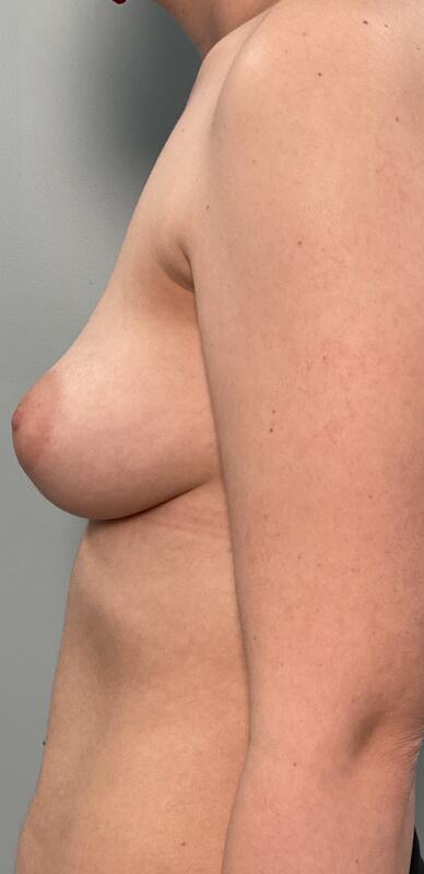 Breast Augmentation Before & After Image
