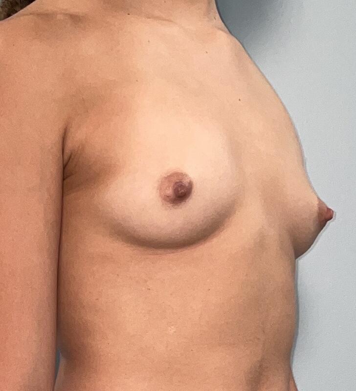 Breast Augmentation Before & After Image