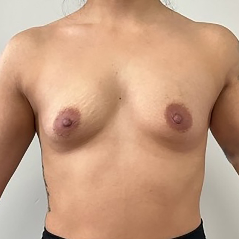 Breast Augmentation Before & After Image
