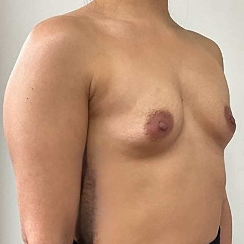Breast Augmentation Before & After Image