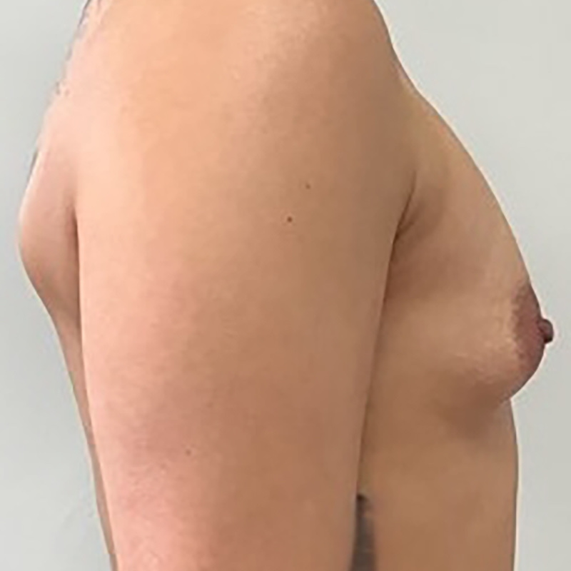 Breast Augmentation Before & After Image