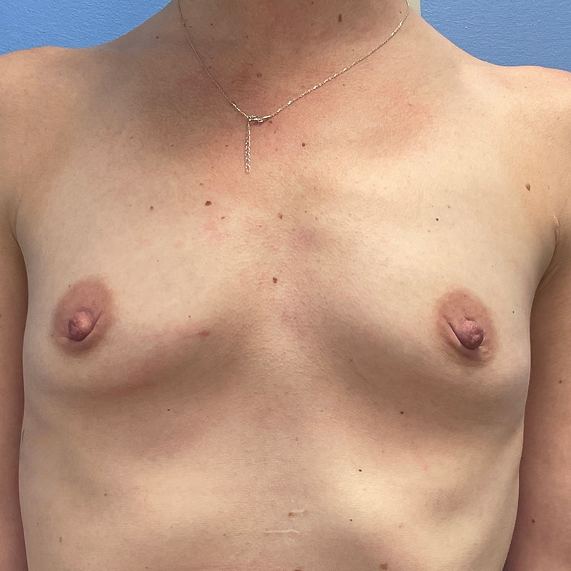 Breast Augmentation Before & After Image