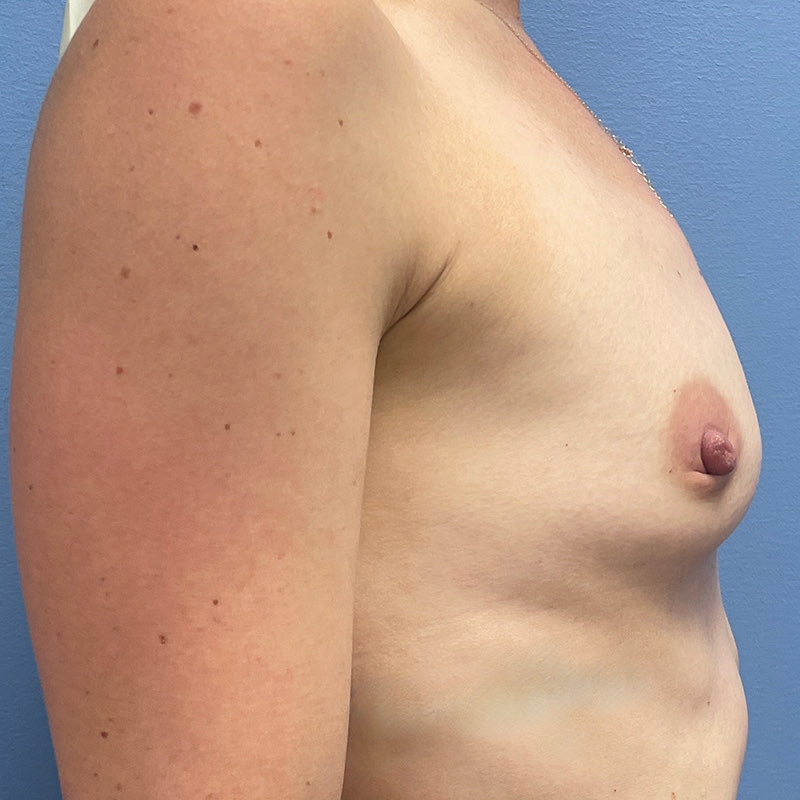 Breast Augmentation Before & After Image