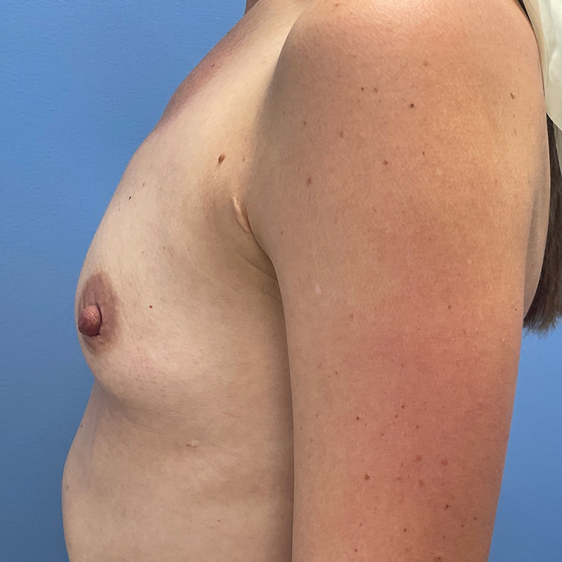 Breast Augmentation Before & After Image