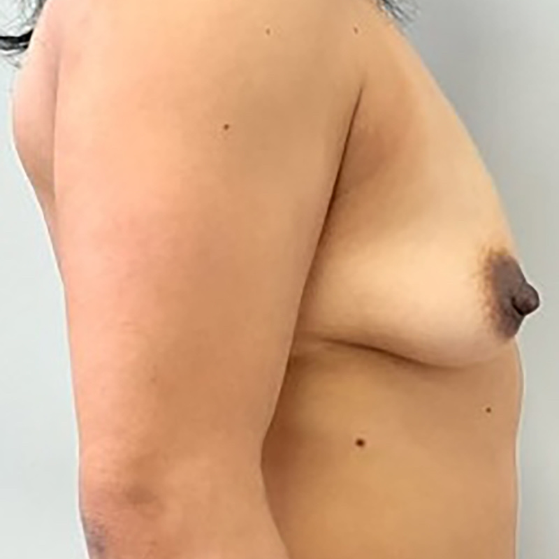 Breast Lift Before & After Image