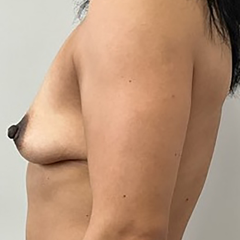 Breast Lift Before & After Image