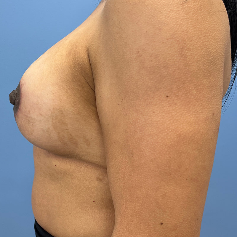 Breast Lift Before & After Image